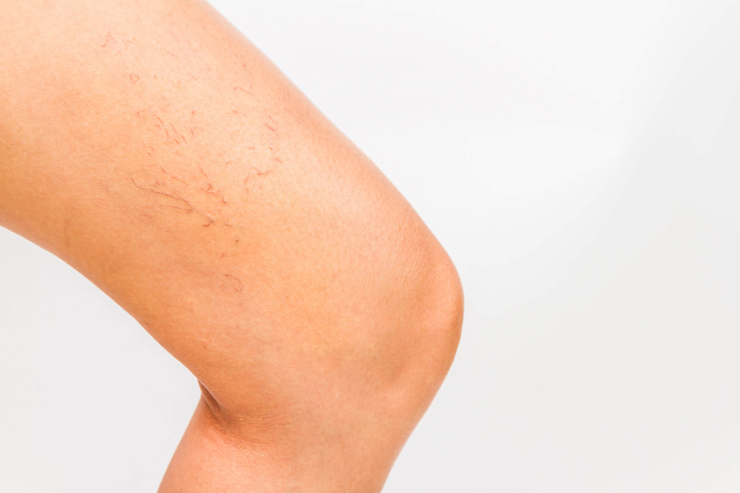 Sclerotherapy for leg spider veins at Miami Skin Spa in Brickell, Miami.