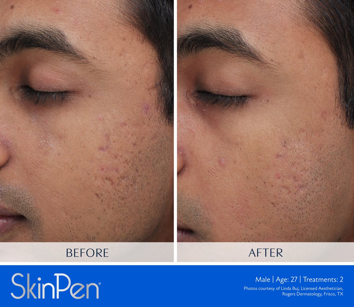 SkinPen microneedling clinical photo — a male patient's cheek acne scarring before treatment and after two treatments