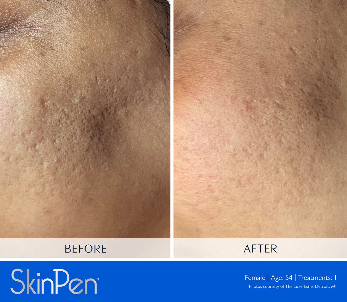 SkinPen microneedling clinical photo — rough cheek texture and shallow scarring before treatment and after a single treatment