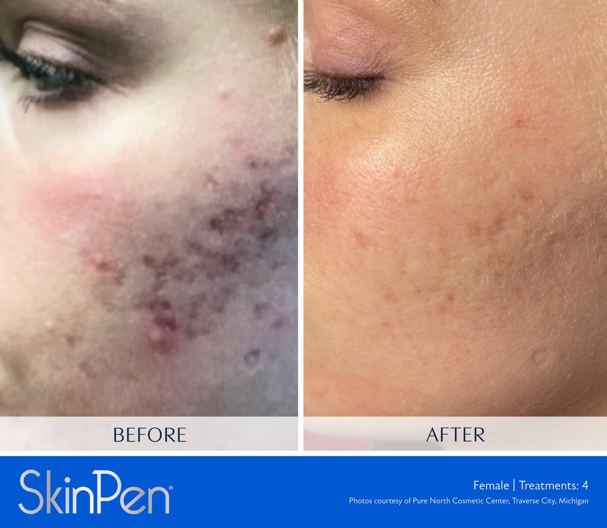SkinPen microneedling clinical photo — deep cystic breakouts and post-acne marks on the cheek before treatment and after four treatments