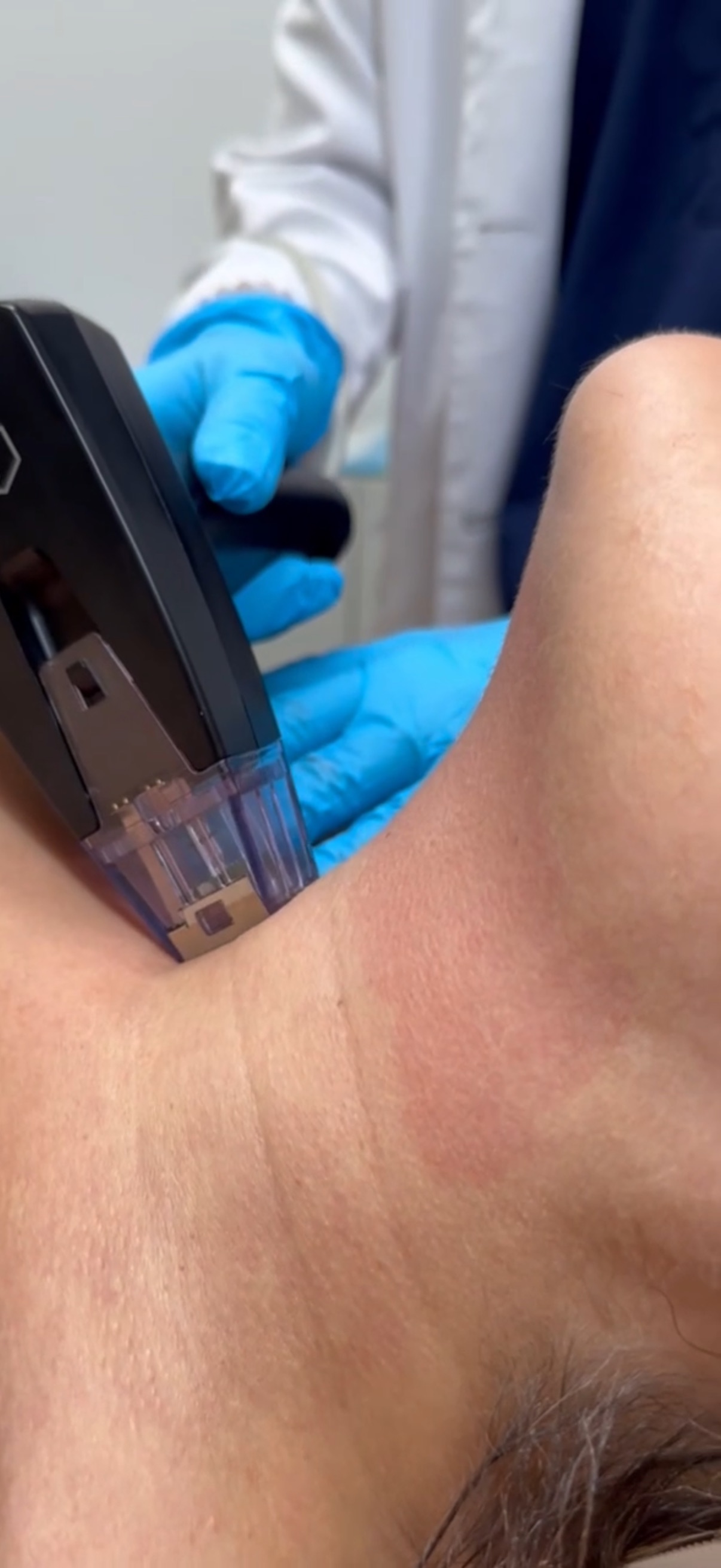 Microneedling handpiece treating the neck during a SkinPen session at Miami Skin Spa in Brickell, Miami