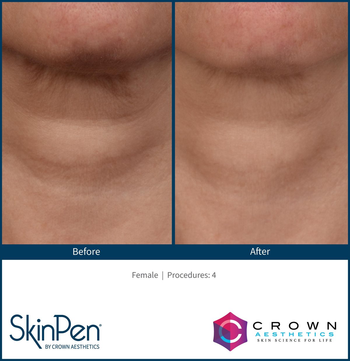 SkinPen microneedling clinical photo — horizontal neck lines before treatment and after four treatments