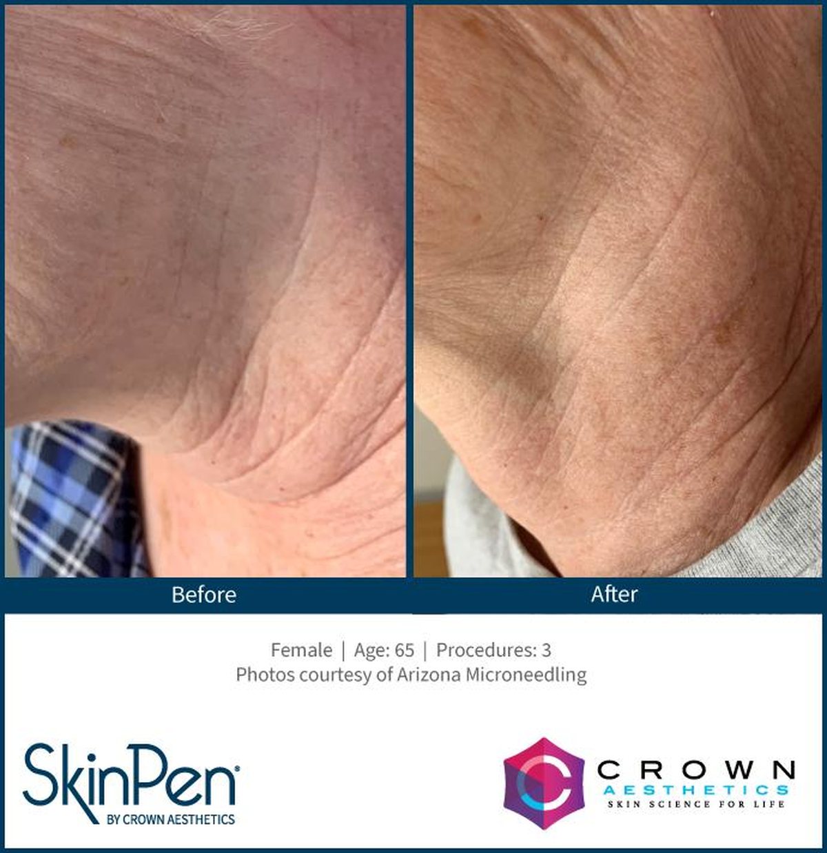 SkinPen microneedling clinical photo — deep neck wrinkles on a 65-year-old patient before treatment and after three treatments