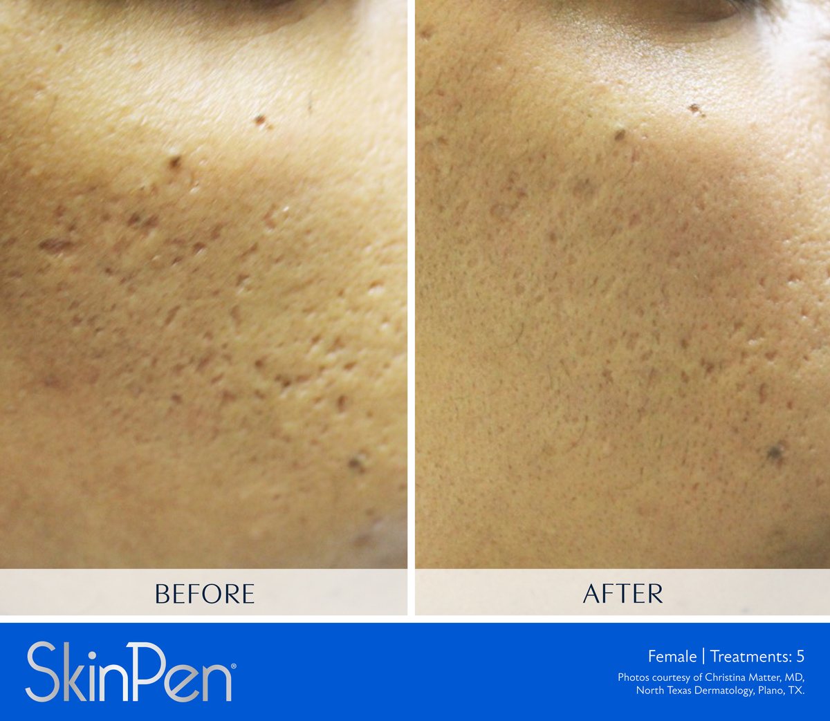 SkinPen microneedling clinical photo — enlarged pores and dark marks on a deeper skin tone before treatment and after five treatments