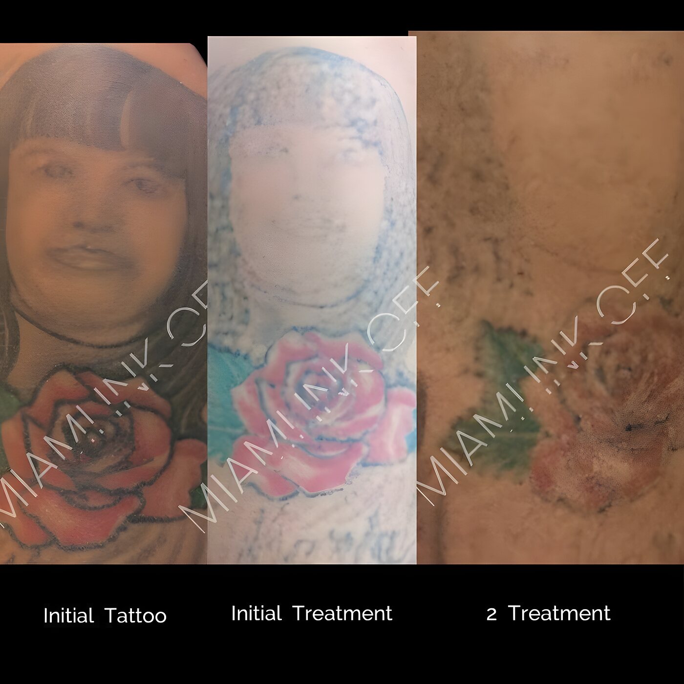 Color portrait and rose upper-arm tattoo faded after two laser tattoo removal sessions.