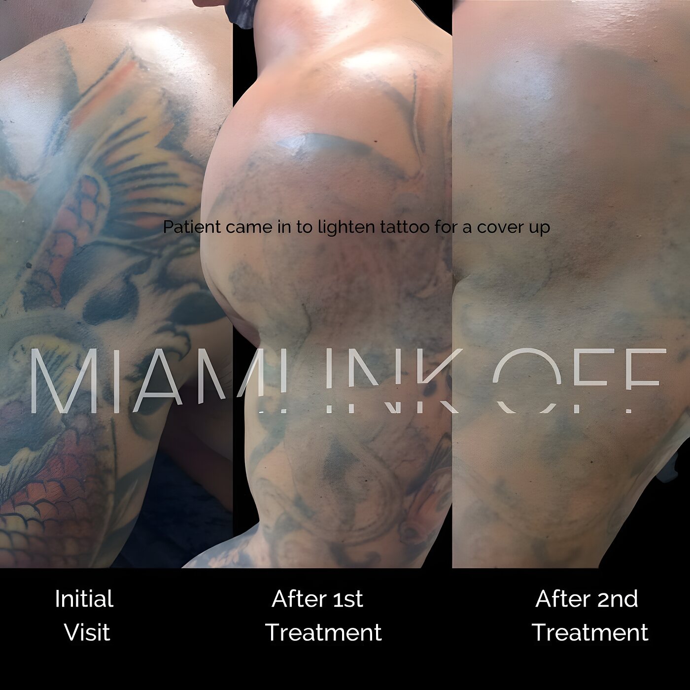 Color koi sleeve tattoo lightened over two laser sessions ahead of a cover-up.