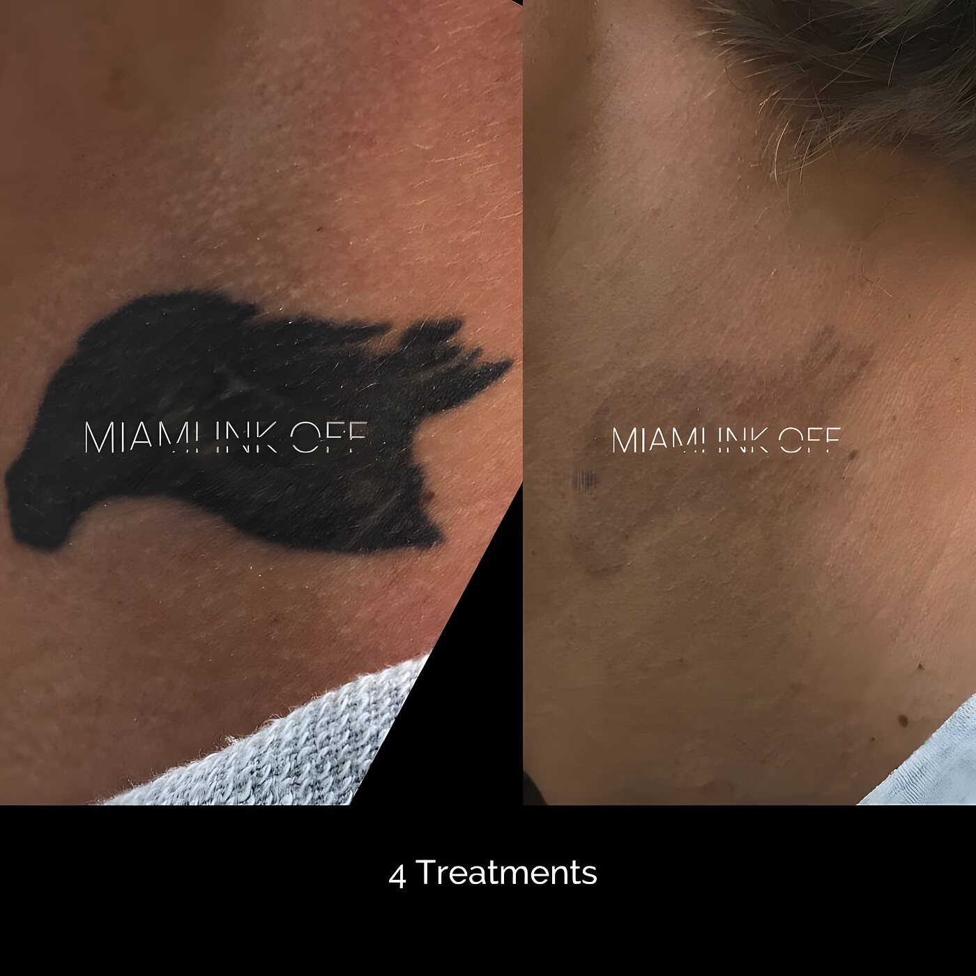 Solid black bird neck tattoo cleared after four laser tattoo removal sessions.
