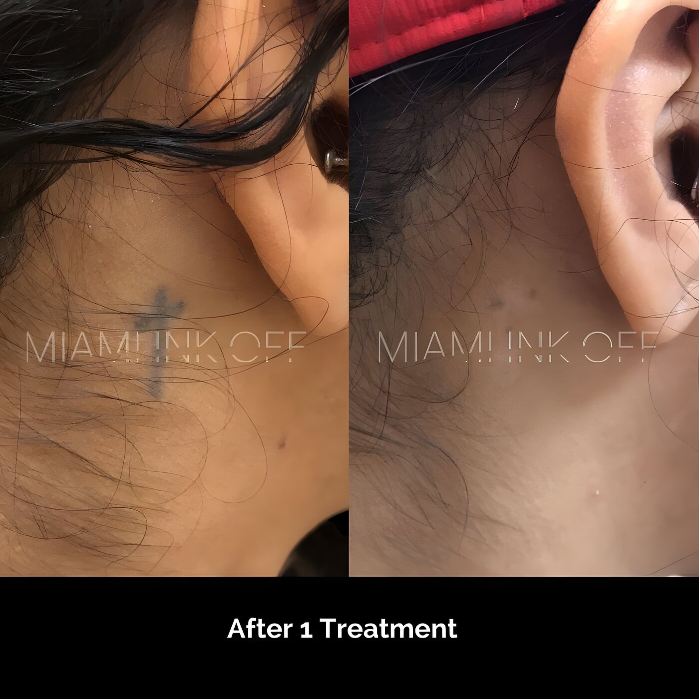 Behind-the-ear cross tattoo faded after one laser tattoo removal session in Brickell, Miami.