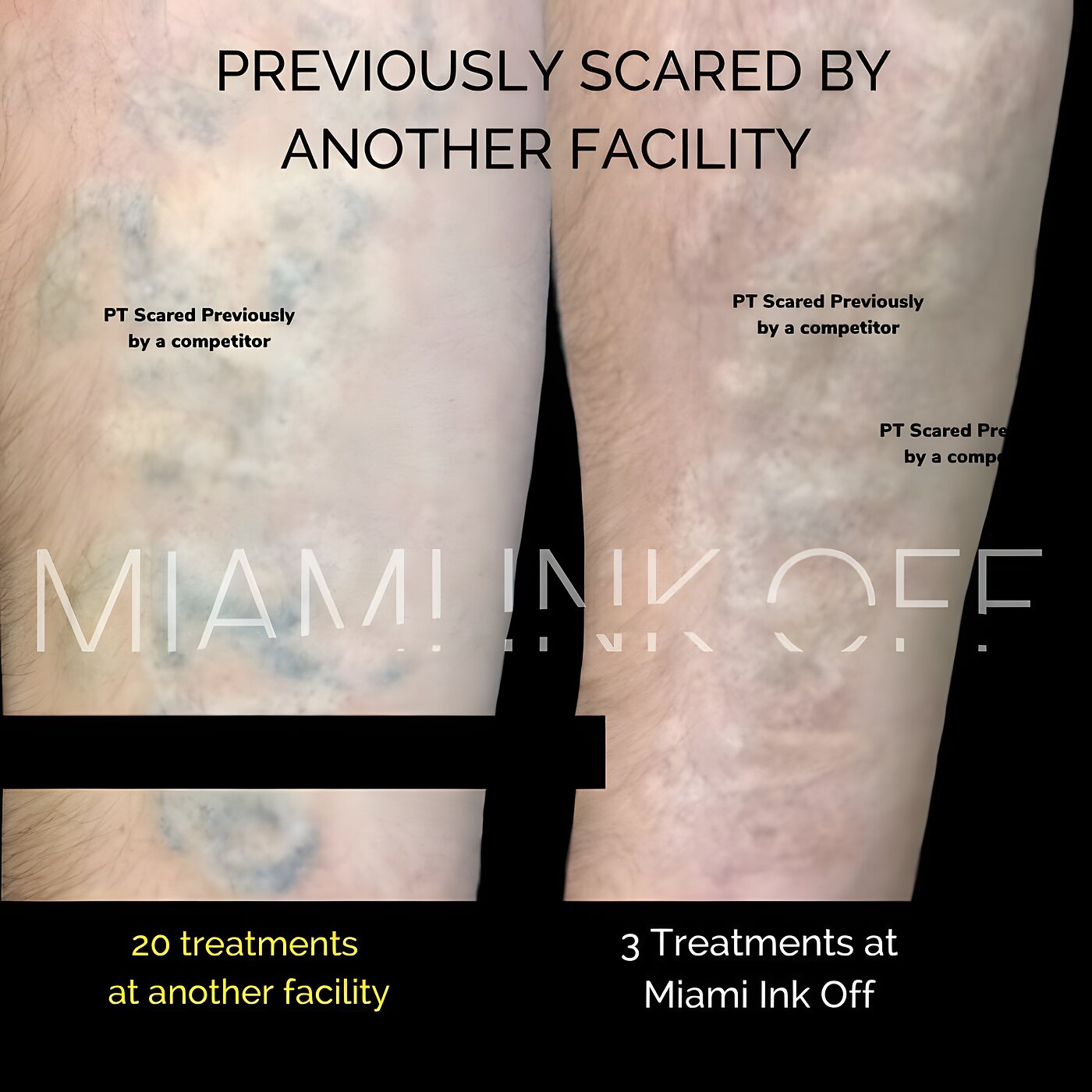 Forearm tattoo showing comparable clearance after three sessions versus twenty sessions elsewhere.